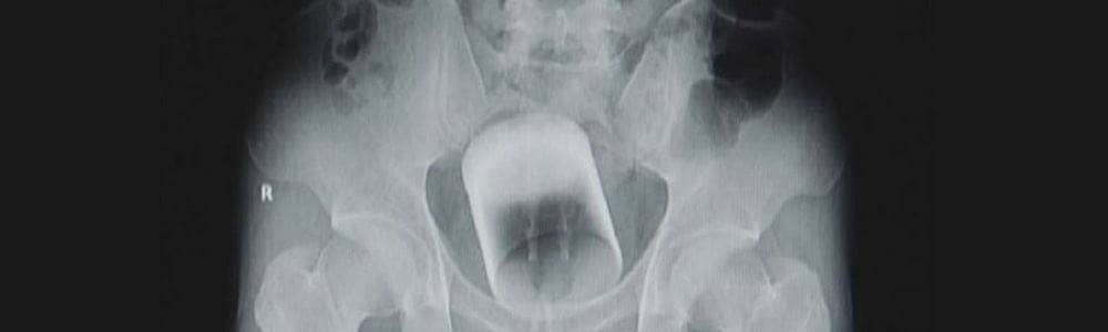 E' andato al pronto soccorso dopo essersi infilato una tazza nel retto