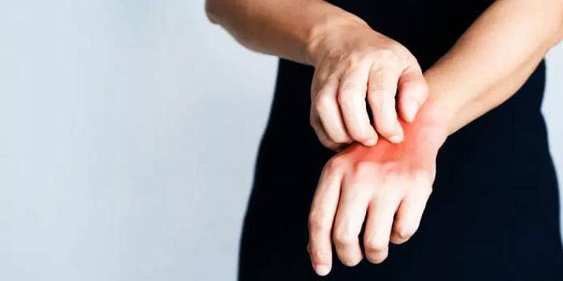 E possibile essere allergici al freddo? 