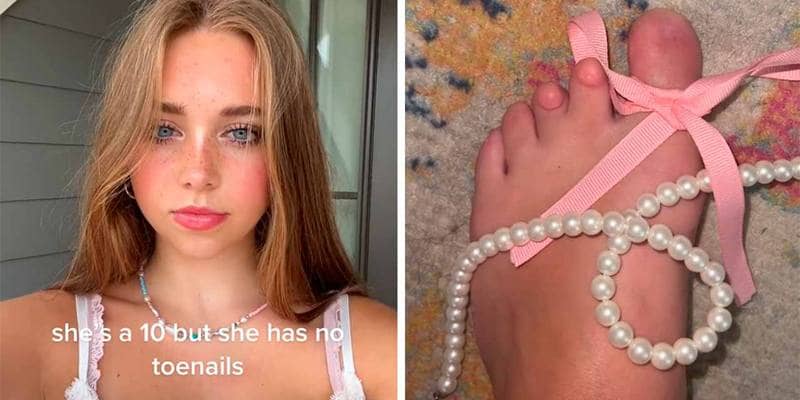 Annabelle Anderson, nata senza unghie dei piedi diventa influencer