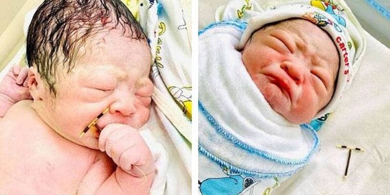 Nasce con la spirale anticoncezionale della mamma in pugno