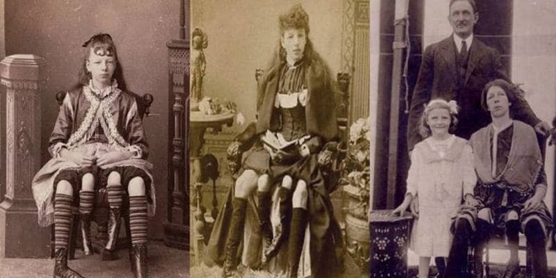 Chi era Josephine Myrtle Corbin, la donna con 4 gambe